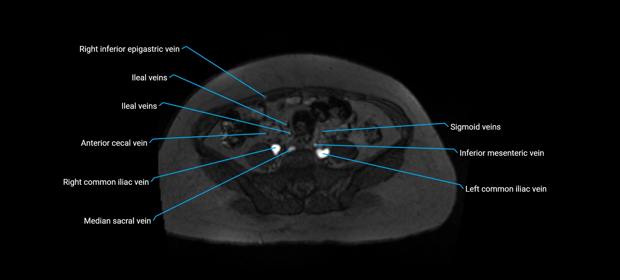 MRV abdomen pelvis & lower limb axial cross sectional anatomy labelled MRI image 129 (1).webp